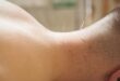 Terapi Akupuntur untuk Mengatasi Sakit Kepala di Efje Klinik Bekasi