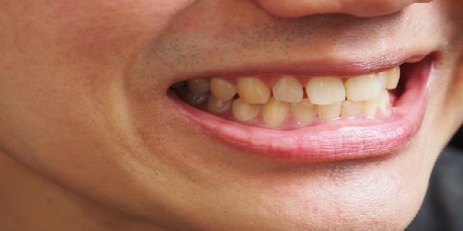 7 Penyebab Gigi Kuning dan Cara Efektif Mengatasinya yang Wajib Kamu Tahu