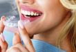 Cara Kerja Aligner Gigi dalam Merapikan Susunan Gigi
