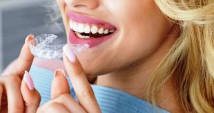 Cara Kerja Aligner Gigi dalam Merapikan Susunan Gigi