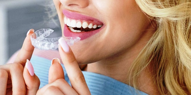 Cara Kerja Aligner Gigi dalam Merapikan Susunan Gigi